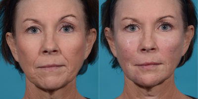bellafill before and after result image 1