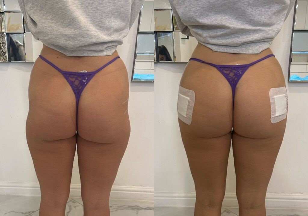 dermal fillers for buttock enlargement