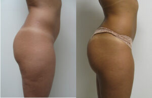 dermal fillers for butt enlargement