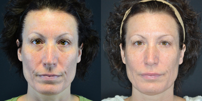 Bellafill before and after result image 4