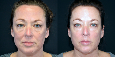 Bellafill before and after result image 3