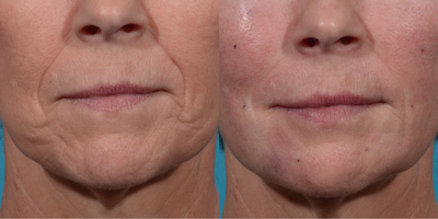 bellafill before and after result image 2